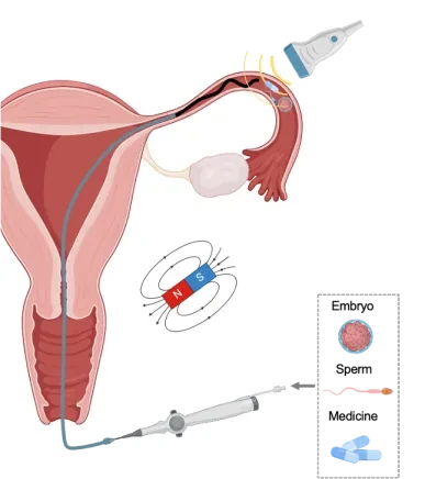 Robotic magnetic microcatheter that traverses the cervix into the vagina and fallopian tubes, actively propelling and pushing the medical tube forward, through which gametes, embryos, or medications are locally released.